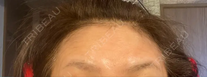 ボトックス（眉間） / ボトックス（額） TCB東京中央美容外科 横浜駅前院 DAY 3 メイン用