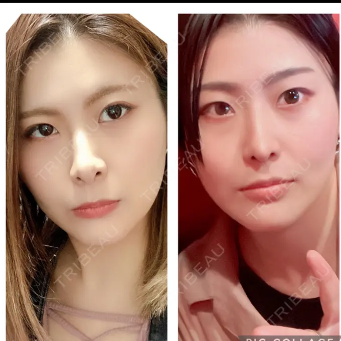 鼻中隔延長（切開） みずほクリニック AFTER メイン用