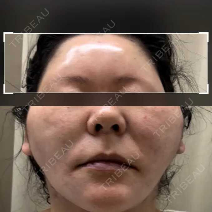 糸リフト / 脂肪吸引（顔） / 脂肪注入（額） / メーラーファット除去 / ジョールファット除去 / 脂肪注入（輪郭） / その他（輪郭） 湘南美容クリニック 秋葉原院 DAY 0 メイン用