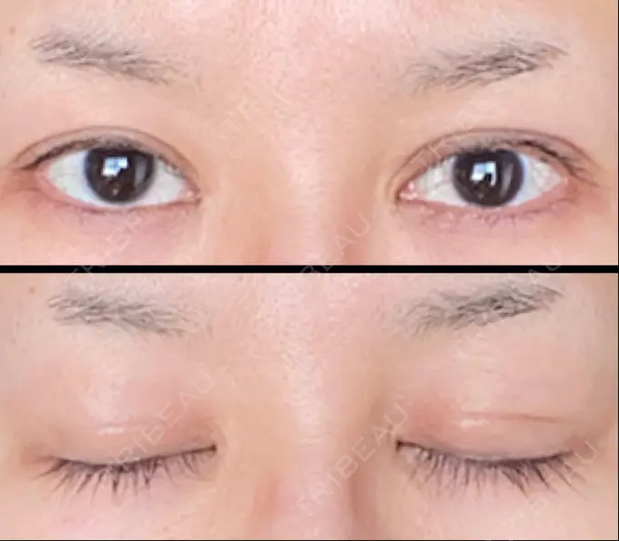 二重切開 / 目頭切開 湘南美容クリニック 六本木院 DAY 87 メイン用