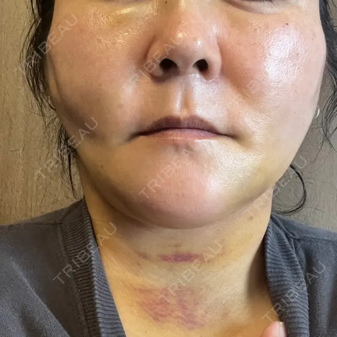 糸リフト / 脂肪吸引（顔） / 脂肪注入（額） / メーラーファット除去 / ジョールファット除去 / 脂肪注入（輪郭） / その他（輪郭） 湘南美容クリニック 秋葉原院 DAY 5 メイン用