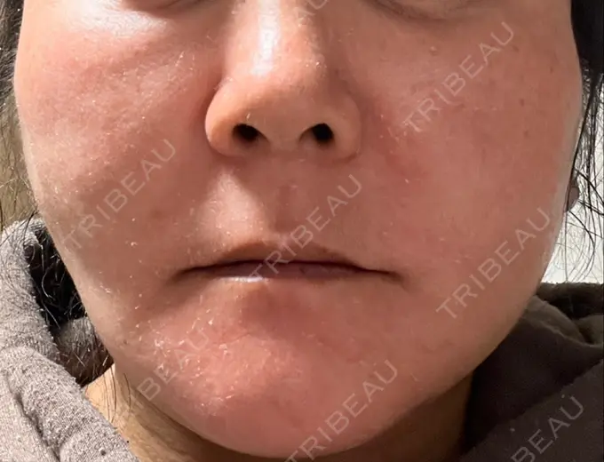 糸リフト / 脂肪吸引（顔） / 脂肪注入（額） / メーラーファット除去 / ジョールファット除去 / 脂肪注入（輪郭） / その他（輪郭） 湘南美容クリニック 秋葉原院 DAY 15 メイン用