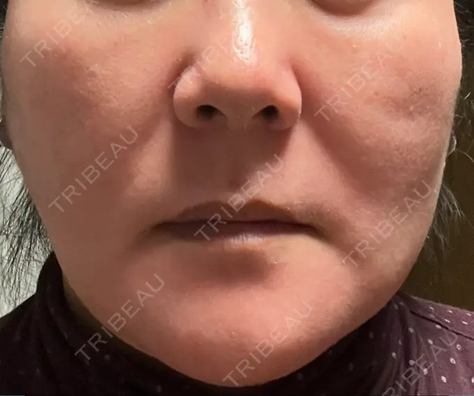 糸リフト / 脂肪吸引（顔） / 脂肪注入（額） / メーラーファット除去 / ジョールファット除去 / 脂肪注入（輪郭） / その他（輪郭） 湘南美容クリニック 秋葉原院 AFTER メイン用