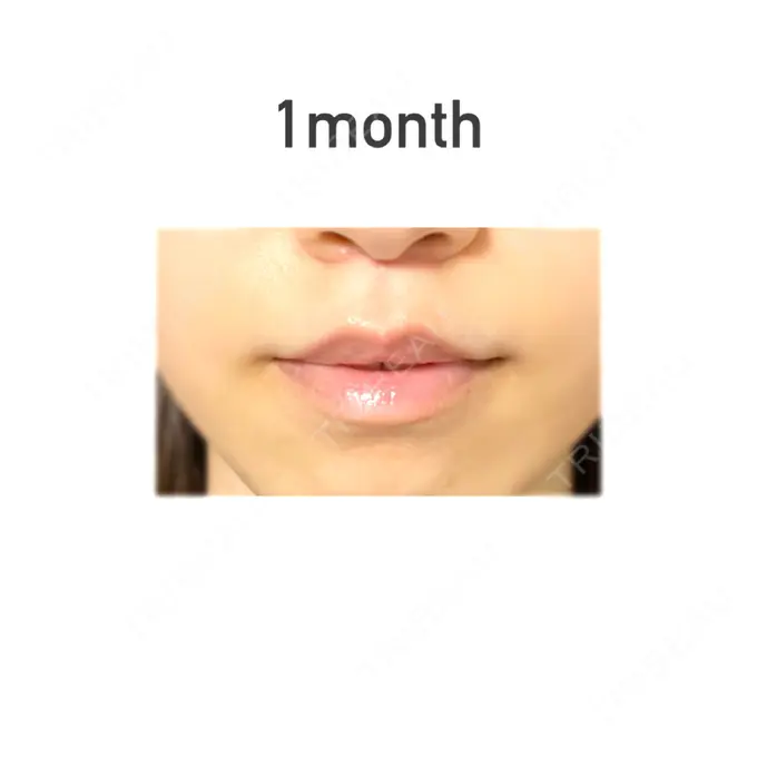 人中短縮 新宿ラクル美容外科クリニック 新宿院 DAY 30 メイン用