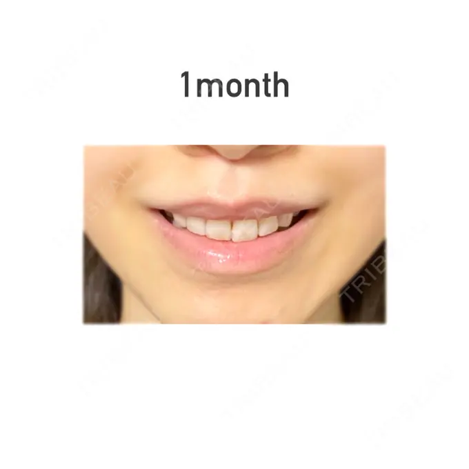 人中短縮 新宿ラクル美容外科クリニック 新宿院 DAY 30 メイン用