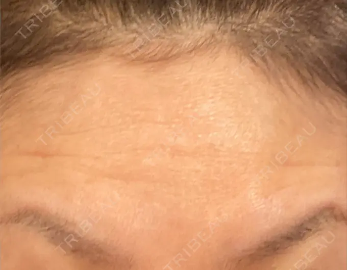 ボトックス（眉間） / ボトックス（額） TCB東京中央美容外科 横浜駅前院 DAY 5 メイン用