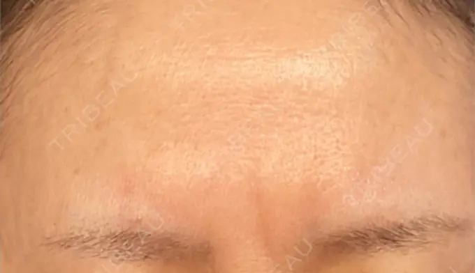 ボトックス（眉間） / ボトックス（額） TCB東京中央美容外科 横浜駅前院 DAY 5 メイン用