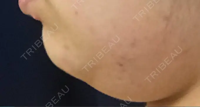 脂肪溶解注射（顔） 東京ロイヤルクリニック DAY 5 メイン用