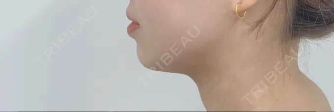 脂肪吸引（顔） 渋谷美容外科クリニック 渋谷院 AFTER メイン用