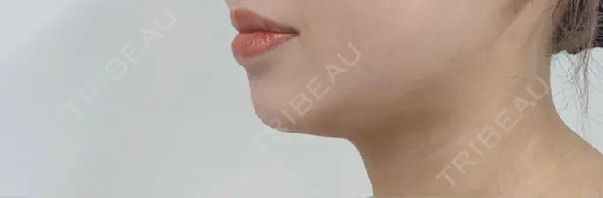 脂肪吸引（顔） 渋谷美容外科クリニック 渋谷院 DAY 79 メイン用