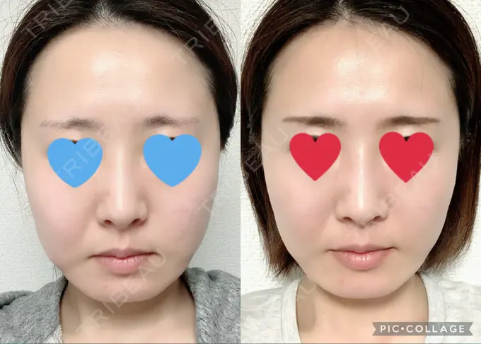 ハイフ（顔） / LED治療 Beauty Clinic the GINZA AFTER メイン用