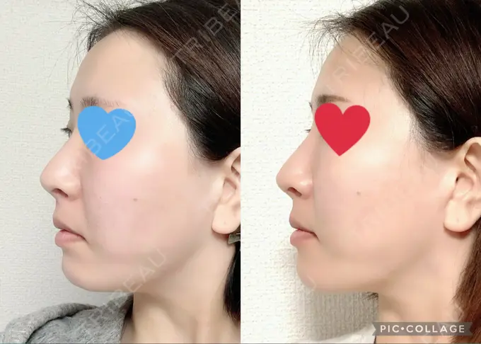 ハイフ（顔） / LED治療 Beauty Clinic the GINZA DAY 12 メイン用