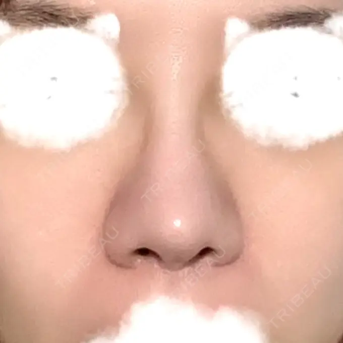 その他（鼻） TCB東京中央美容外科 八王子院 DAY 25 メイン用