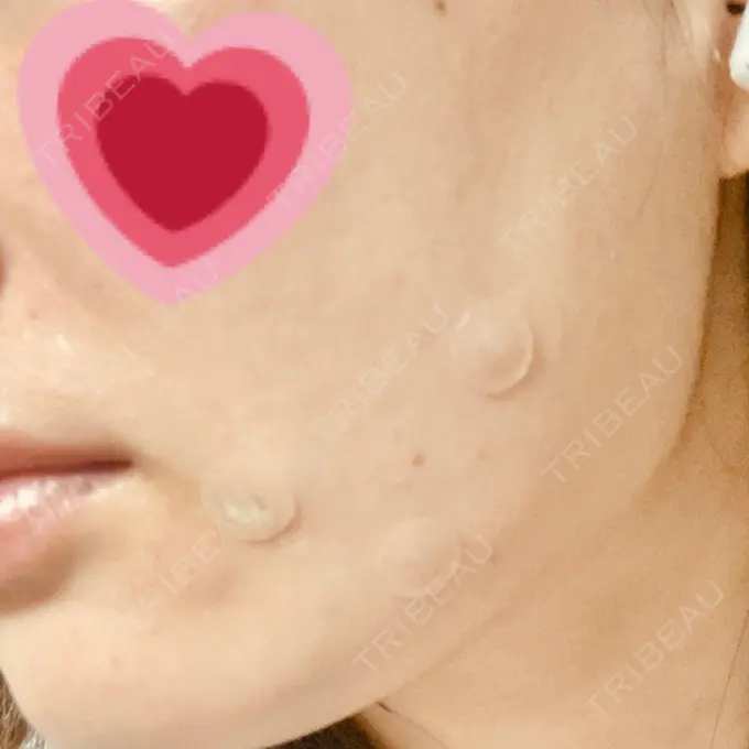 ほくろ・いぼ除去レーザー（肌） エースクリニック 大阪梅田HEPナビオ院 DAY 0 メイン用