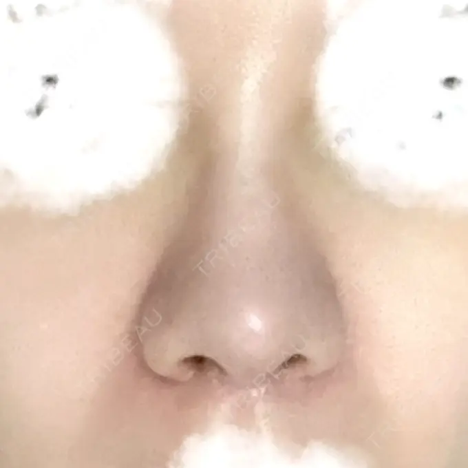 その他（鼻） TCB東京中央美容外科 八王子院 DAY 27 メイン用