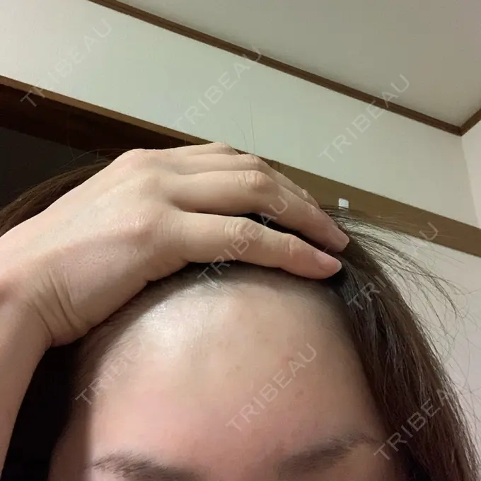 ヒアルロン酸注入（額） / ボトックス（眉間） TCB東京中央美容外科 郡山院 DAY 7 メイン用