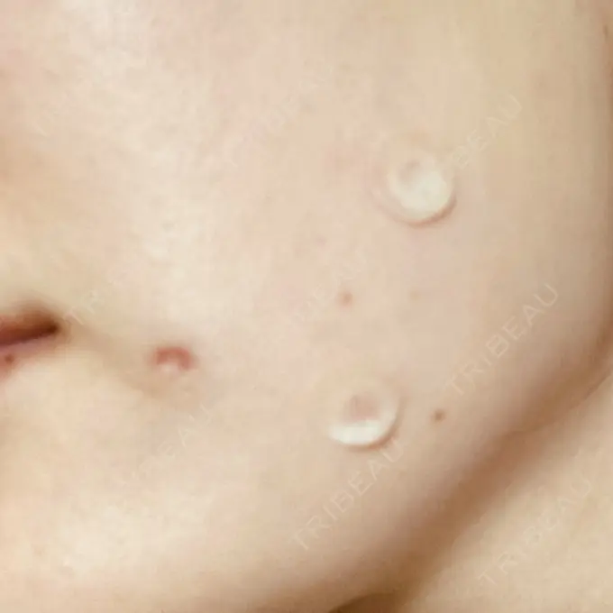 ほくろ・いぼ除去レーザー（肌） エースクリニック 大阪梅田HEPナビオ院 DAY 1 メイン用