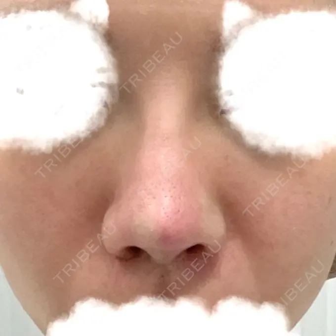 その他（鼻） TCB東京中央美容外科 八王子院 DAY 27 メイン用