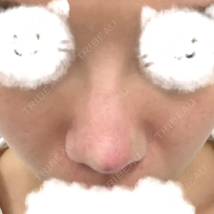 その他（鼻） TCB東京中央美容外科 八王子院 DAY 27 メイン用