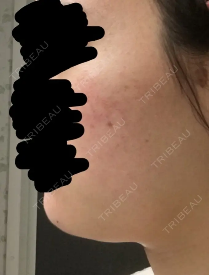 その他（肌） / 再生医療 / PRP皮膚再生療法 聖心美容クリニック 六本木院 DAY 7 メイン用