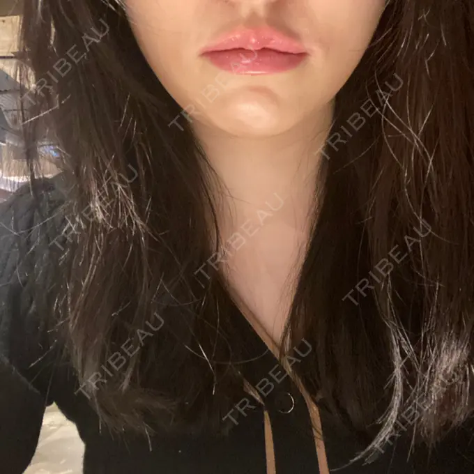 ヒアルロン酸注入（唇） / ボトックス（口角） id美容クリニック 銀座院 AFTER メイン用