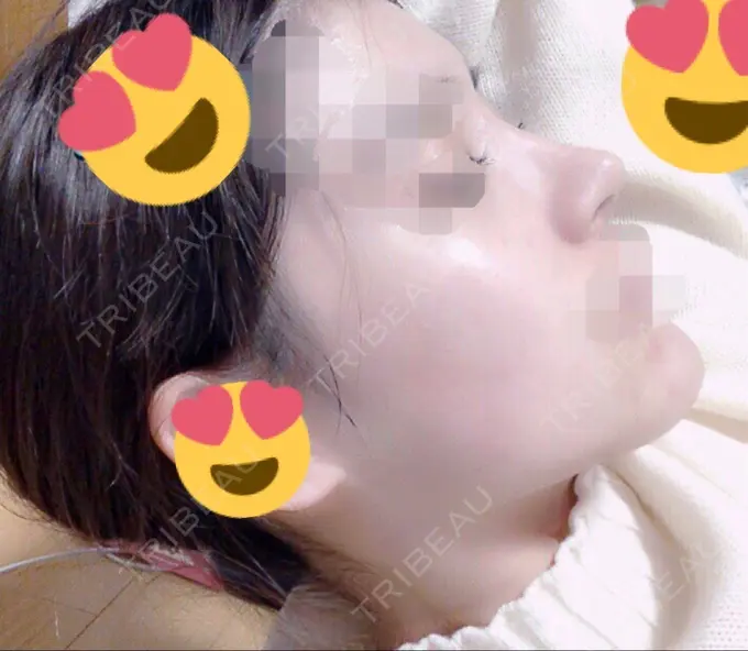 隆鼻術 / 軟骨移植 / プロテーゼ除去 FROM B整形外科 (旧バウム整形外科) DAY 214 メイン用