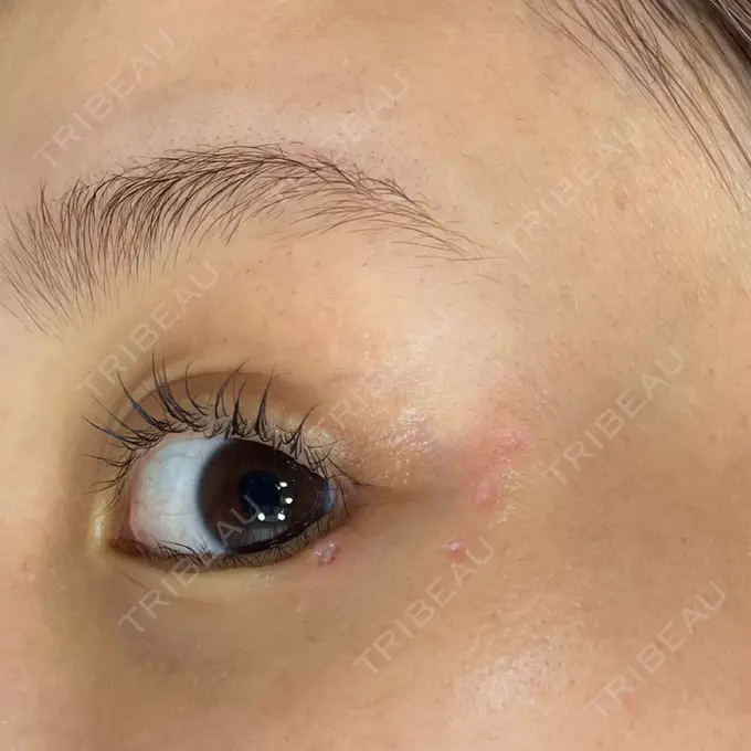 ほくろ・いぼ除去レーザー（肌） Fellez Clinic【フェルズクリニック】 DAY 0 メイン用