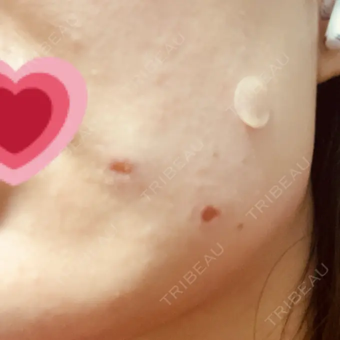 ほくろ・いぼ除去レーザー（肌） エースクリニック 大阪梅田HEPナビオ院 AFTER メイン用