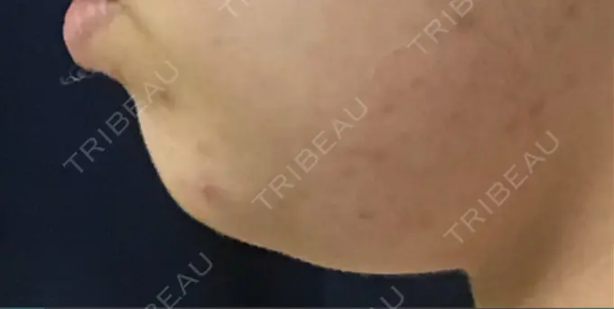 脂肪溶解注射（顔） 東京ロイヤルクリニック DAY 10 メイン用