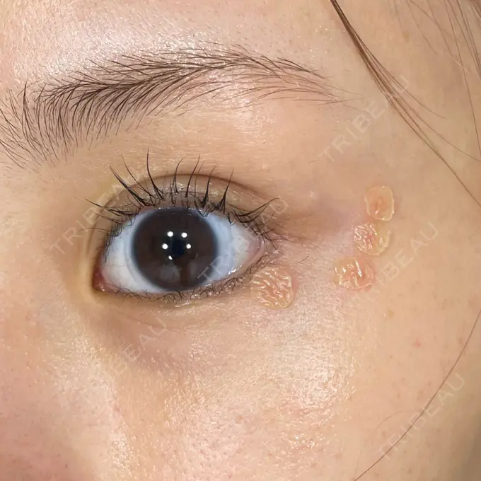 ほくろ・いぼ除去レーザー（肌） Fellez Clinic【フェルズクリニック】 DAY 2 メイン用