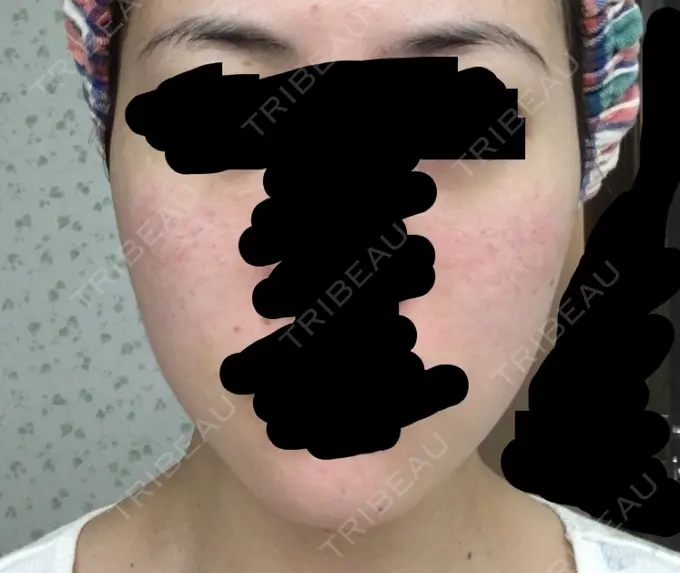 その他（肌） / 再生医療 / PRP皮膚再生療法 聖心美容クリニック 六本木院 DAY 7 メイン用