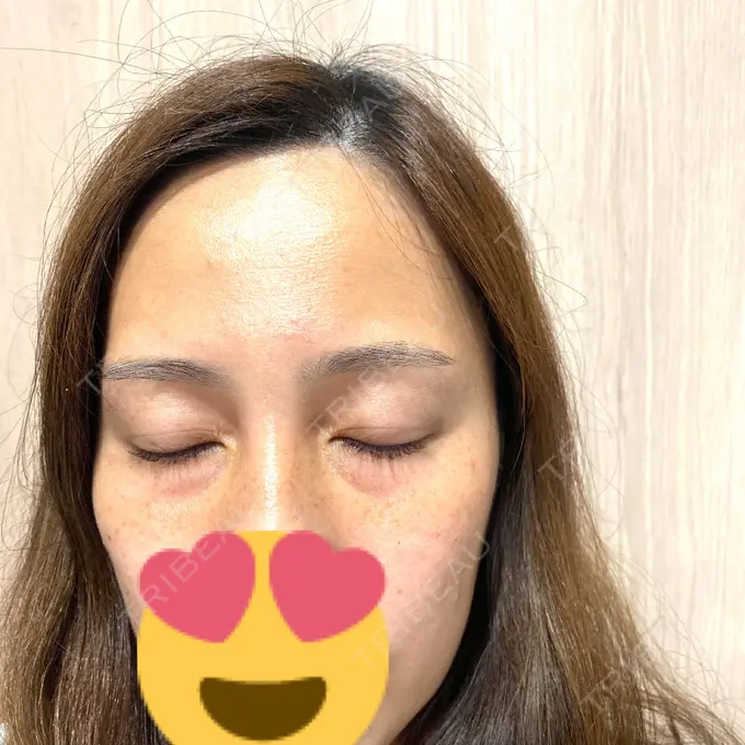 毛穴洗浄（ハイドラフェイシャルなど） SUBCLi（＆ABCクリニック） AFTER メイン用