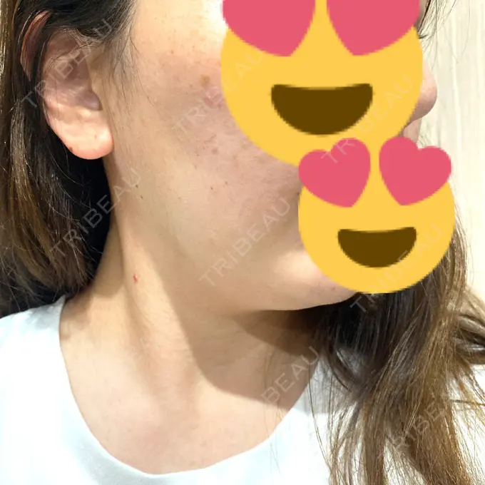 毛穴洗浄（ハイドラフェイシャルなど） SUBCLi（＆ABCクリニック） DAY 21 メイン用