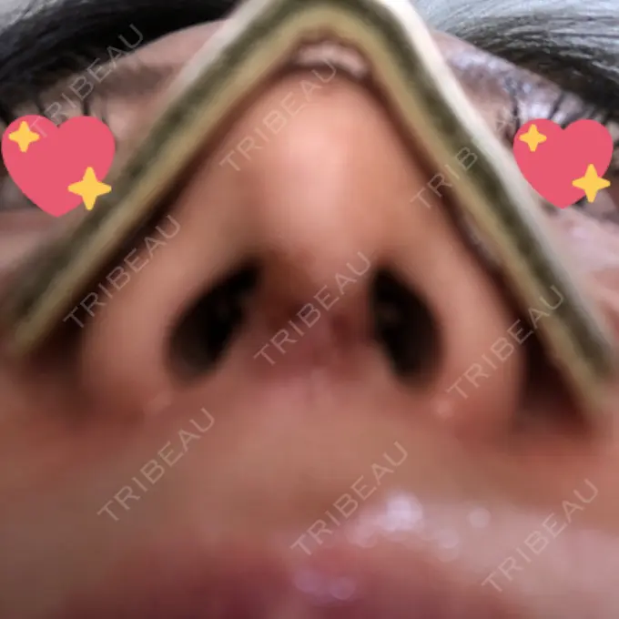 軟骨移植 / ワシ鼻修正・ハンプ切除 / 鼻尖縮小 聖心美容クリニック 名古屋院 DAY 6 メイン用