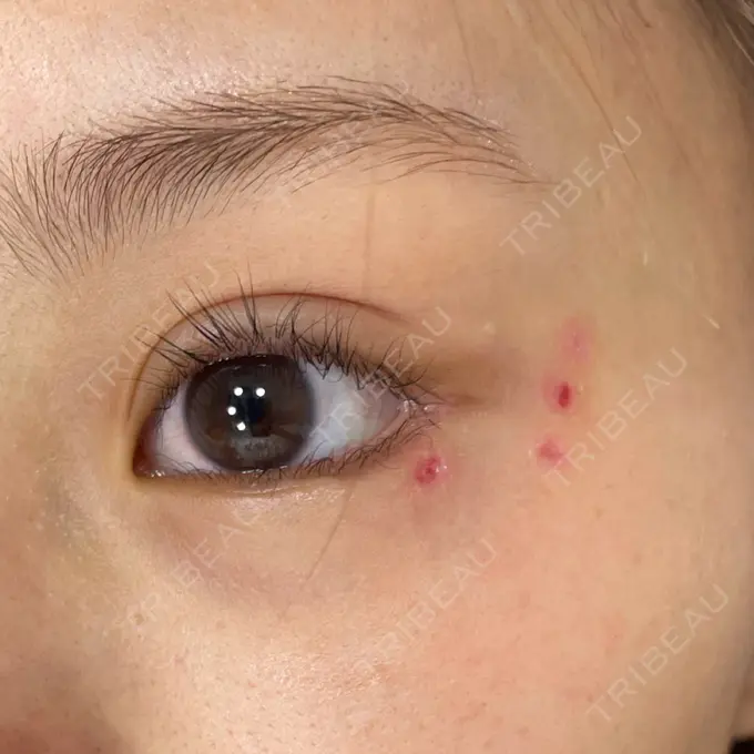 ほくろ・いぼ除去レーザー（肌） Fellez Clinic【フェルズクリニック】 DAY 3 メイン用