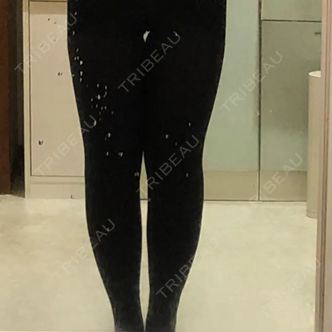 脂肪吸引（脚） / 脂肪吸引（お尻） / その他（ボディ） 湘南美容クリニック 名古屋院 DAY 3 メイン用