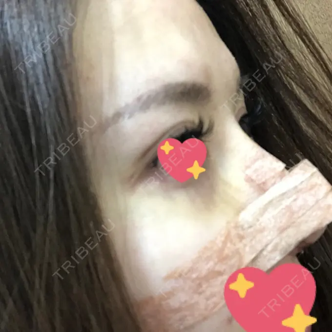 軟骨移植 / ワシ鼻修正・ハンプ切除 / 鼻尖縮小 聖心美容クリニック 名古屋院 DAY 7 メイン用