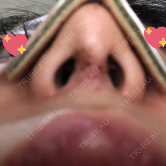 軟骨移植 / ワシ鼻修正・ハンプ切除 / 鼻尖縮小 聖心美容クリニック 名古屋院 DAY 7 メイン用