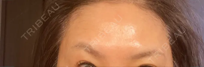 ボトックス（眉間） / ボトックス（額） TCB東京中央美容外科 横浜駅前院 AFTER メイン用