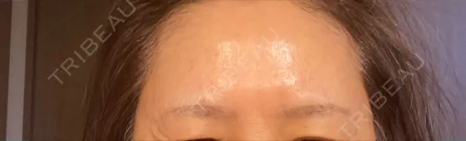 ボトックス（眉間） / ボトックス（額） TCB東京中央美容外科 横浜駅前院 DAY 14 メイン用