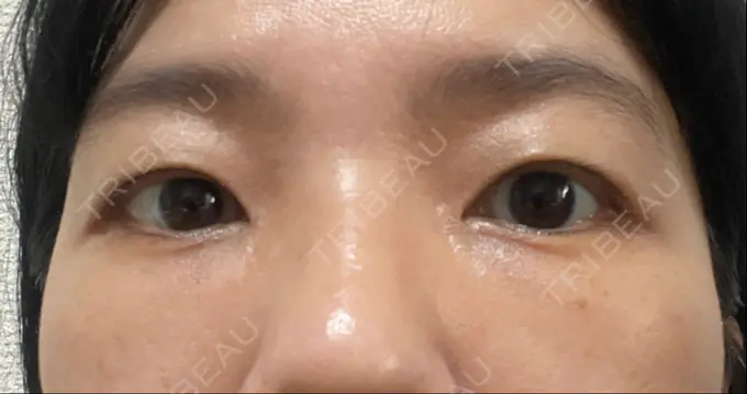 クマ治療 / 下まぶたたるみ取り セオリークリニック DAY 14 メイン用