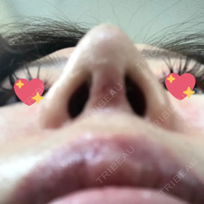 軟骨移植 / ワシ鼻修正・ハンプ切除 / 鼻尖縮小 聖心美容クリニック 名古屋院 DAY 8 メイン用