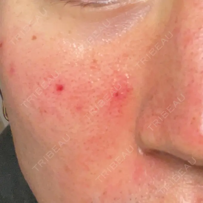 ピーリング（ニキビ・毛穴） / ダーマペン オーマイクリニック【Oh My Clinic】 DAY 0 メイン用