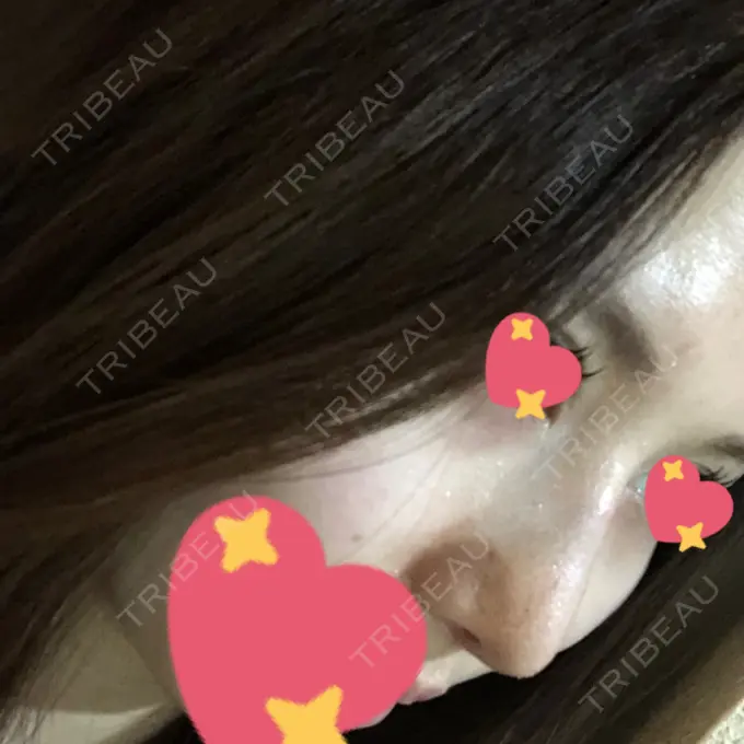 軟骨移植 / ワシ鼻修正・ハンプ切除 / 鼻尖縮小 聖心美容クリニック 名古屋院 DAY 8 メイン用