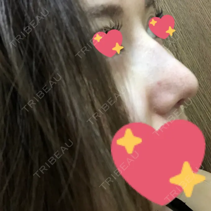 軟骨移植 / ワシ鼻修正・ハンプ切除 / 鼻尖縮小 聖心美容クリニック 名古屋院 DAY 9 メイン用