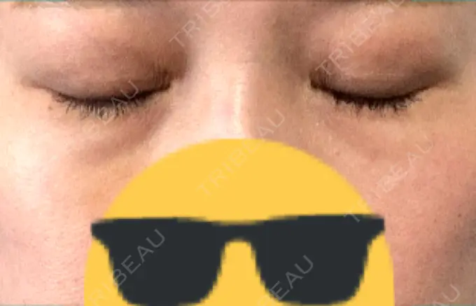 ヒアルロン酸注入（目の下） 渋谷美容外科クリニック 渋谷院 DAY 8 メイン用