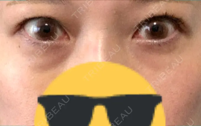 ヒアルロン酸注入（目の下） 渋谷美容外科クリニック 渋谷院 DAY 8 メイン用