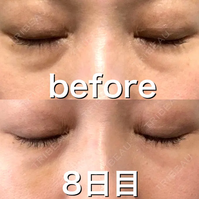 ヒアルロン酸注入（目の下） 渋谷美容外科クリニック 渋谷院 DAY 8 メイン用