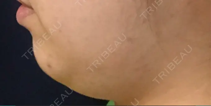 脂肪溶解注射（顔） 東京ロイヤルクリニック DAY 15 メイン用