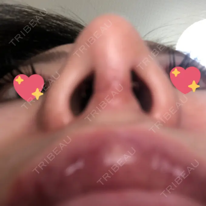 軟骨移植 / ワシ鼻修正・ハンプ切除 / 鼻尖縮小 聖心美容クリニック 名古屋院 DAY 10 メイン用